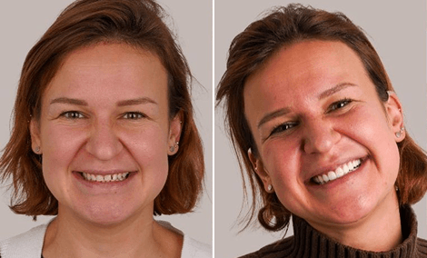 Transformação do sorriso com Digital Smile Design