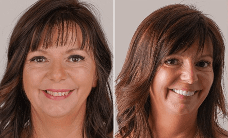 Restauração dos dentes da frente com facetas