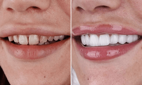 Reabilitação oral completa sobre implantes