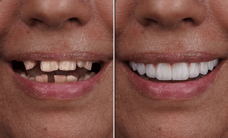 Transformação do sorriso após o reaparecimento da coloração