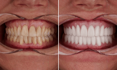 Design personalizado do sorriso e branqueamento