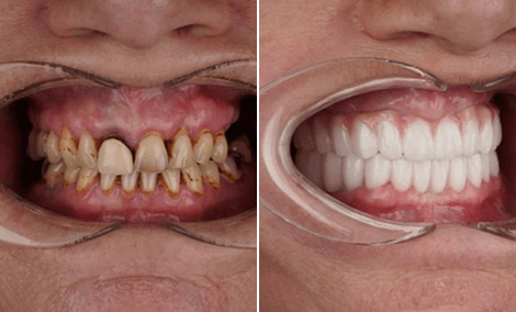 Design completo do sorriso com facetas