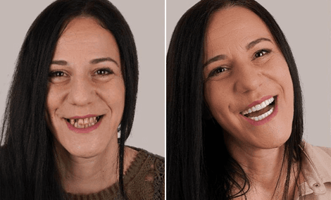 Transformação do sorriso com contorno gengival