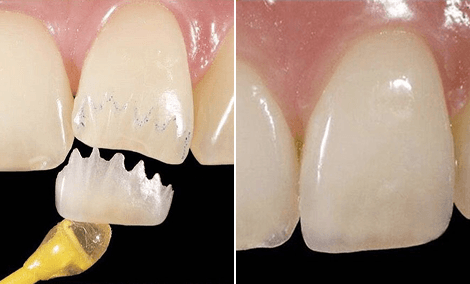 Dente da frente lascado restaurado com uma única faceta