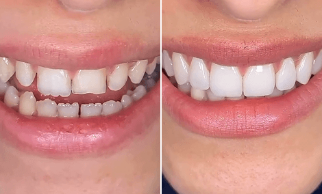 Transformação completa do sorriso — espaços fechados e alinhamento corrigido