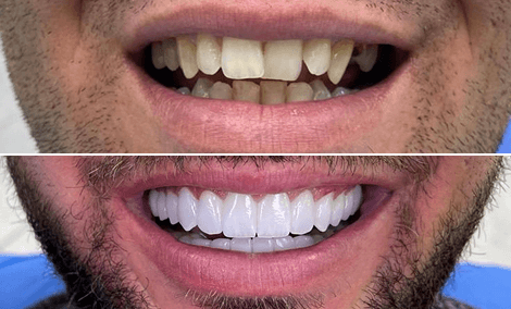 Transformação completa do sorriso — remodelação, alinhamento e branqueamento