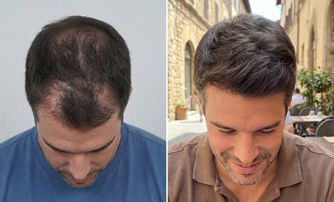Frontal third and crown hair restoration
