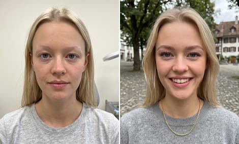 Wiederherstellung von Schläfen und Haarrändern