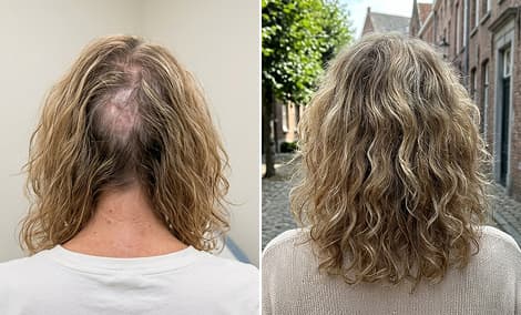 Narben- und Haarwiederherstellung im Hinterkopfbereich