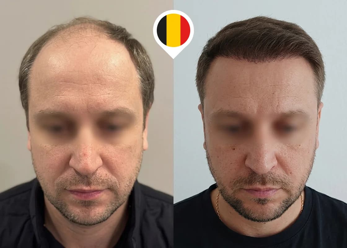 Restauración de la línea frontal en retroceso y la zona frontal debilitada