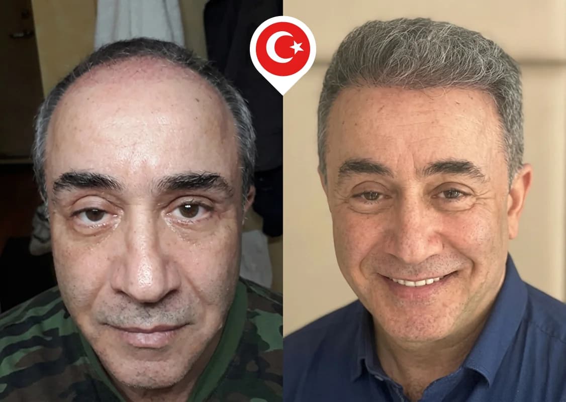 Restauración de la línea frontal en retroceso y la densidad frontal