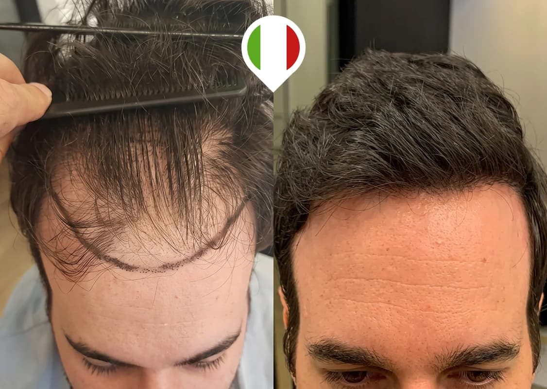 Rediseño de la línea frontal y restauración de las sienes