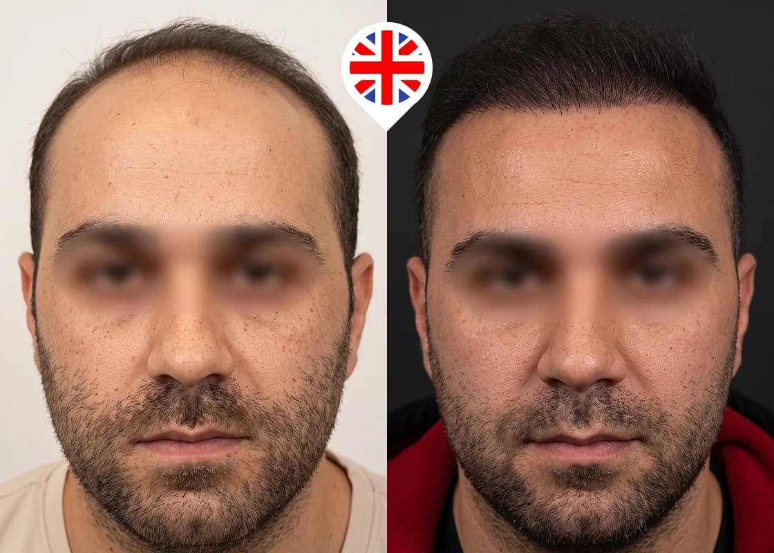Descenso de la línea frontal y restauración de las entradas