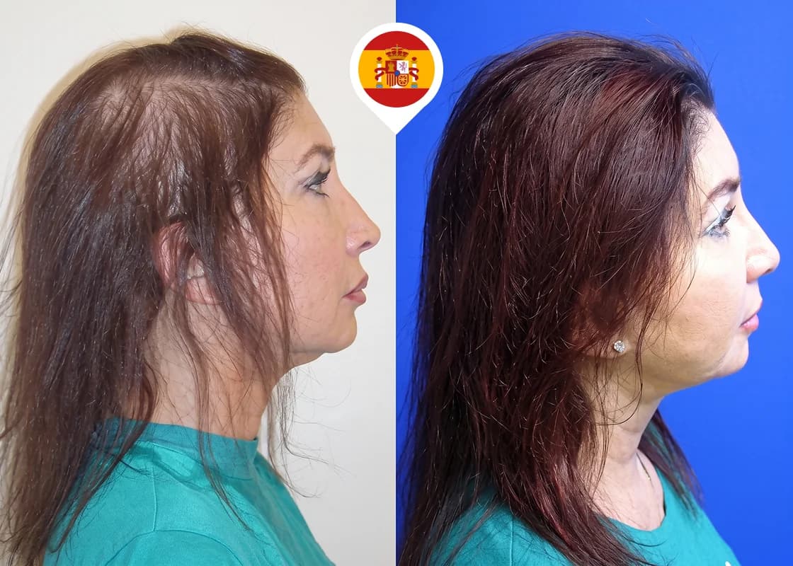 Restauración del cabello debilitado en la parte superior