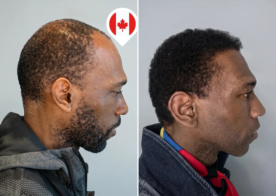 Restauración de la zona frontal y la coronilla en cabello afro
