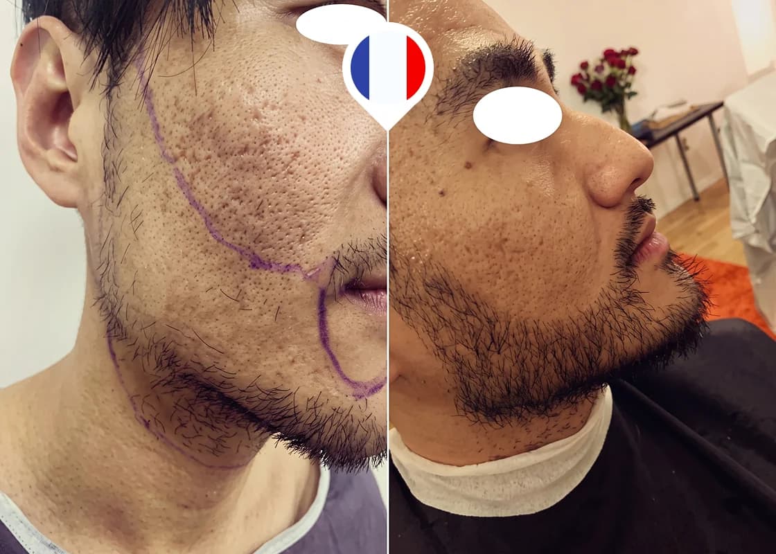 Mejillas despobladas y unión del bigote con la barba