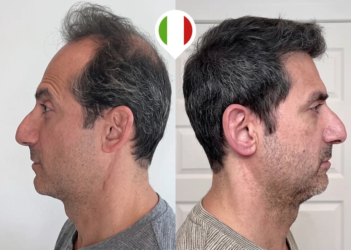 Restauración de la línea frontal en retroceso y la densidad de la coronilla
