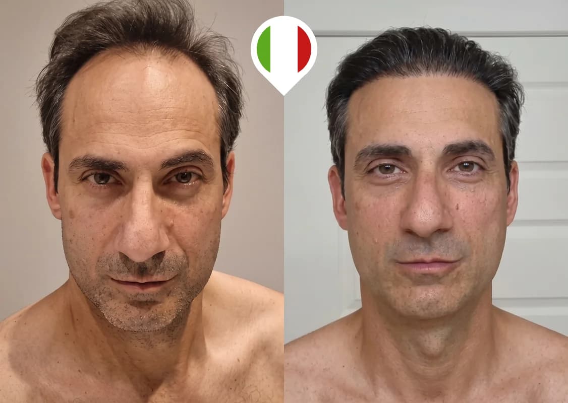 Restauración de la línea frontal en retroceso y la densidad de la coronilla