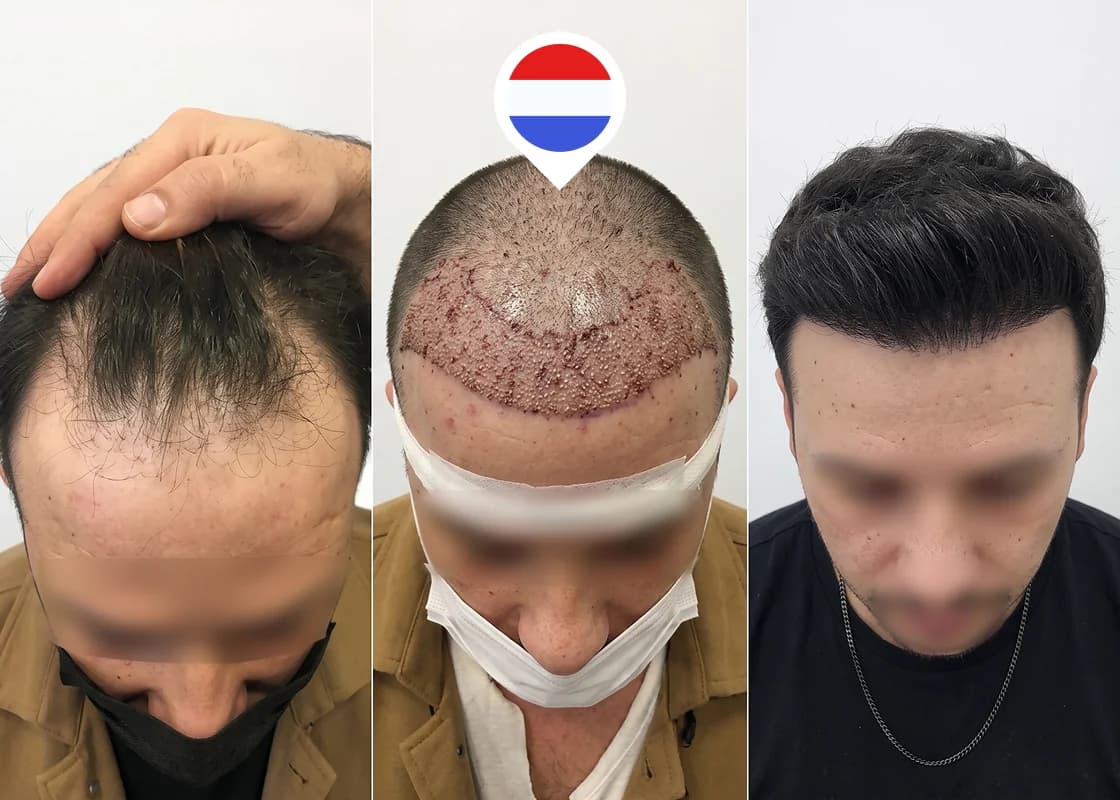 Restauración de la línea frontal en retroceso y la zona frontal