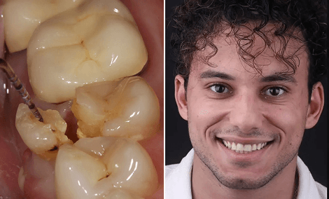 Molari cariati restaurati con 3 corone in ceramica