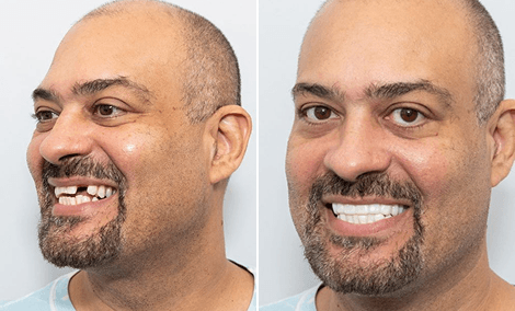 Fehlender Zahn ersetzt — Implantat und Bleaching