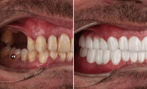 Zwei fehlende Seitenzähne ersetzt — Implantate und Bleaching