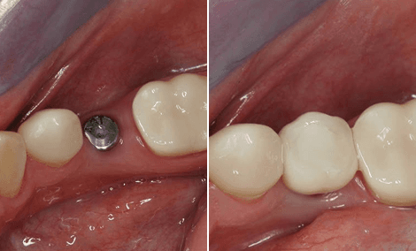 Fehlender Zahn durch ein einzelnes Implantat ersetzt
