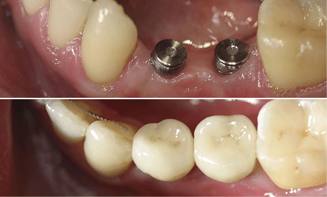 Zwei verlorene Zähne mit Implantaten wiederhergestellt