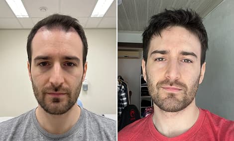 Before and after an M-shaped hairline transplant
