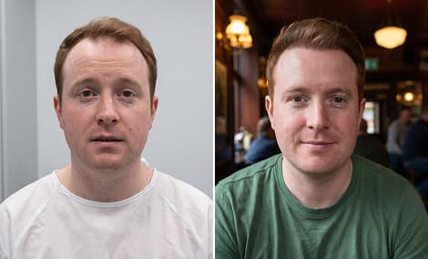 Before and after a temple transplant